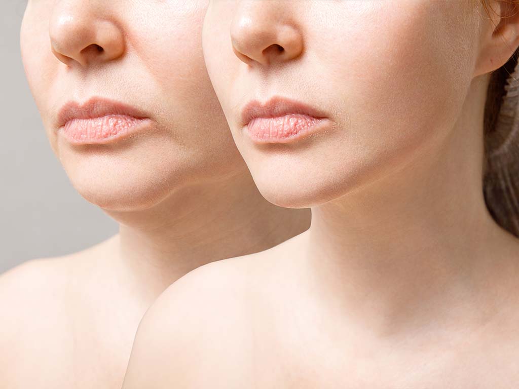 Are Non-Surgical Facelifts Worth Considering?