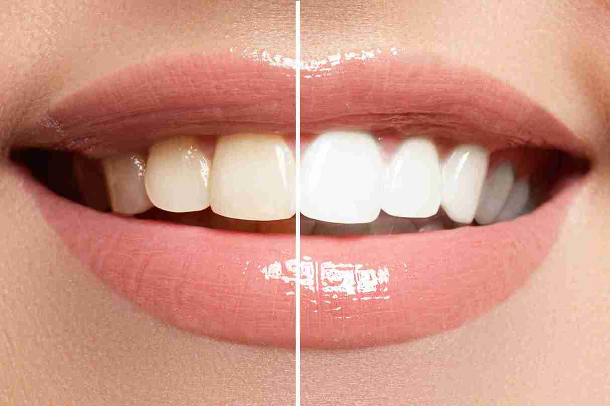 7 Unconventional Yet Effective Hacks for a Radiantly White Smile_11zon