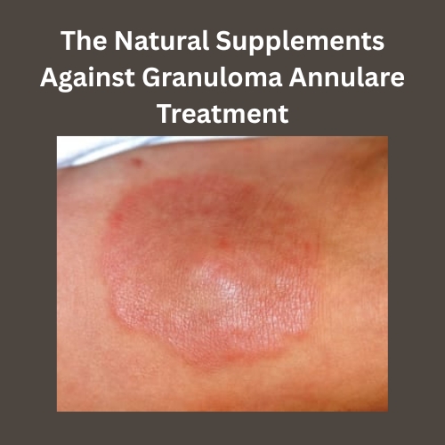 The Natural Supplements Against Granuloma Annulare Treatment