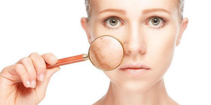 Melasma in Women: Causes, Hormones, and Cure