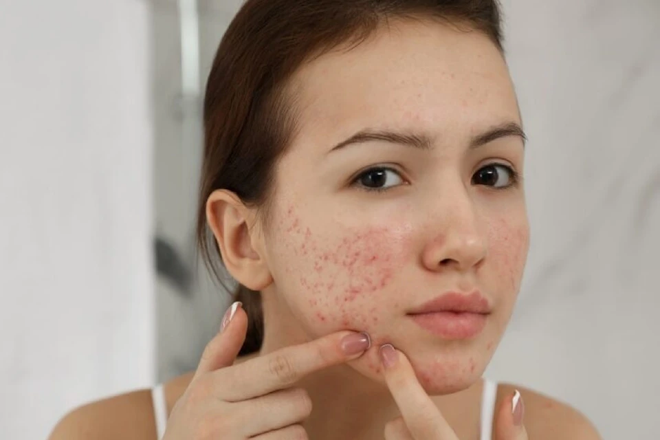 Acne Treatment for Kids and Adults