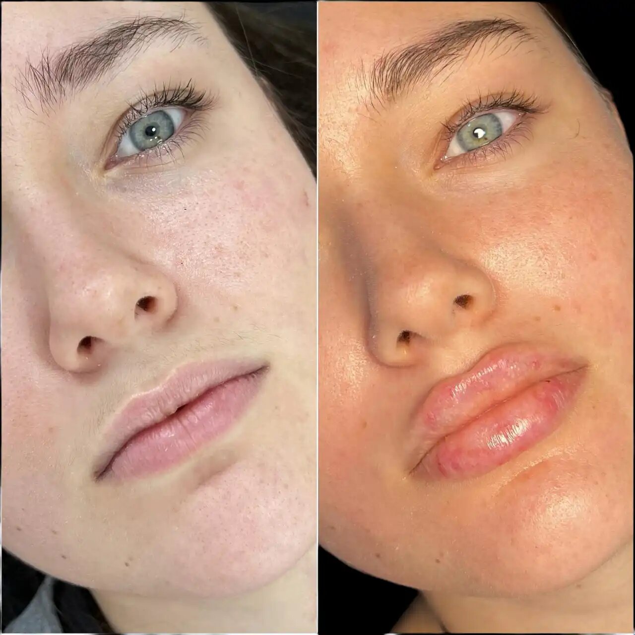 Fillers in Dubai: The Safe, Affordable Alternative to Facelifts