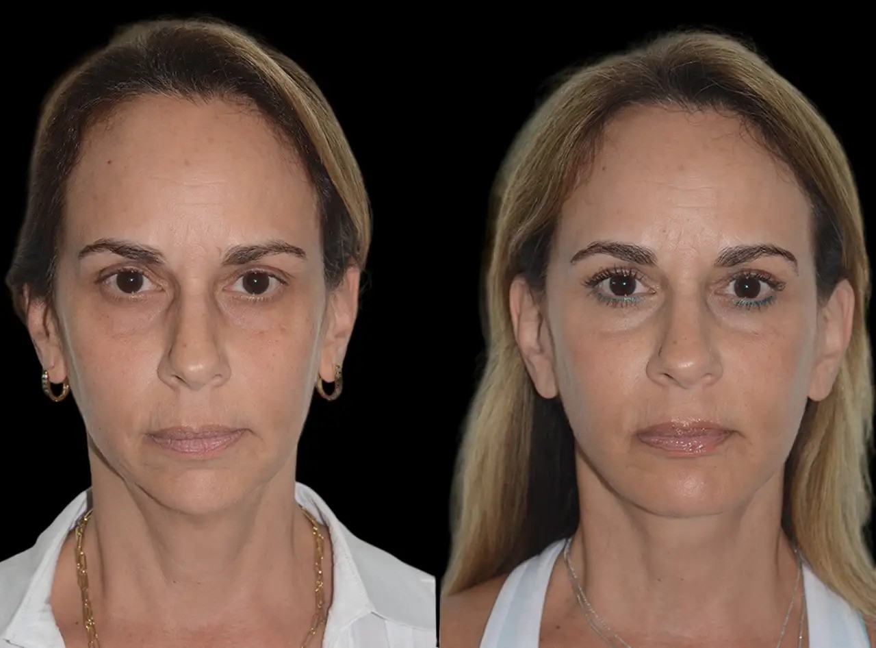 How Chin Fillers from the Best Plastic Surgeon in Dubai Can Transform Your Look