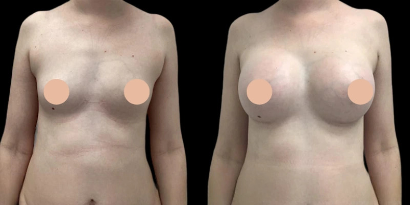 Breast Augmentation in Dubai: Procedure, Cost, and Recovery