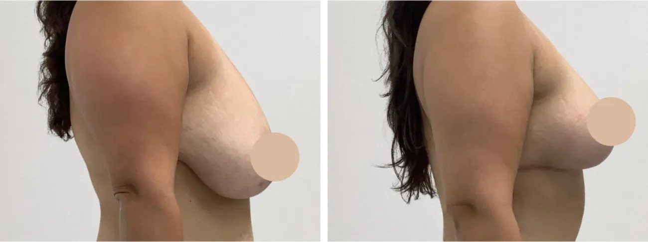 How a Breast Lift in Dubai Can Boost Your Confidence