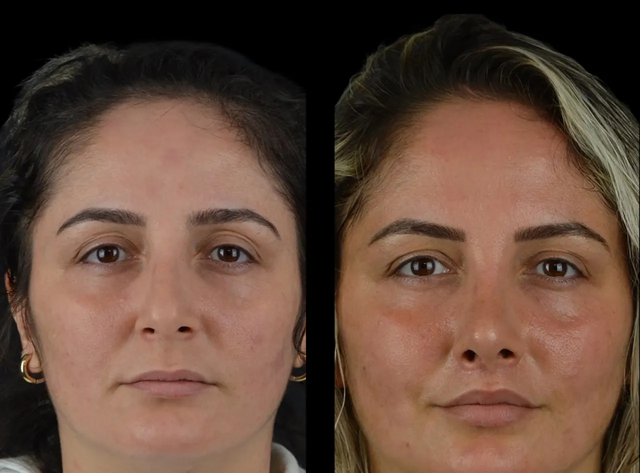 How to Find a Qualified Practitioner for Cheek Fillers in Dubai