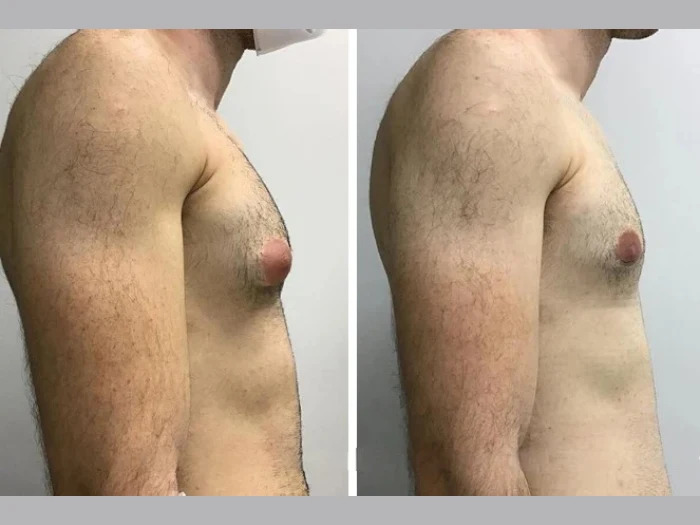 What Happens During a Consultation for Gynecomastia in Dubai?