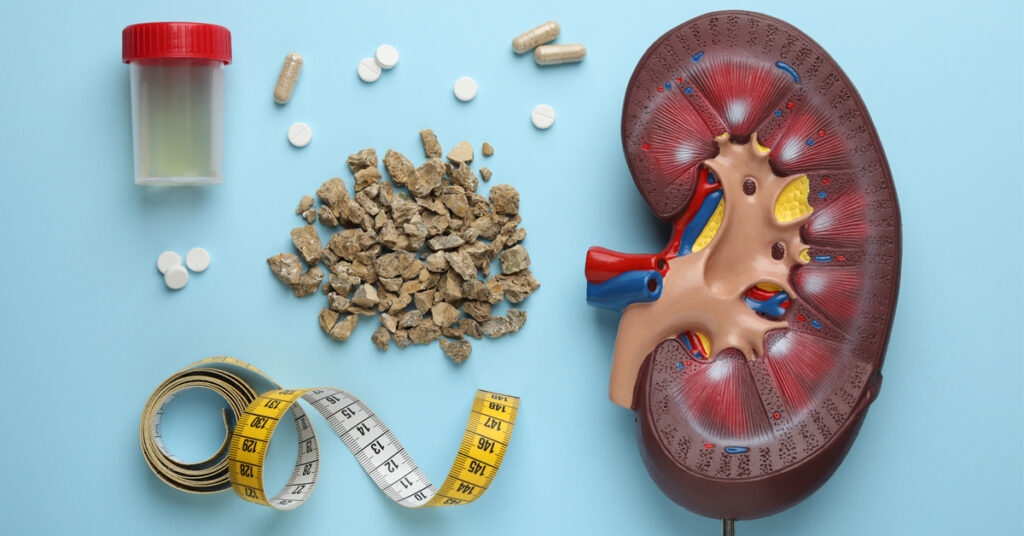 Kidney Stones