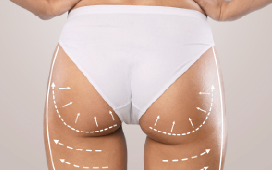 How Long Does a Butt Fat Transfer in Dubai Last? Understanding the Longevity