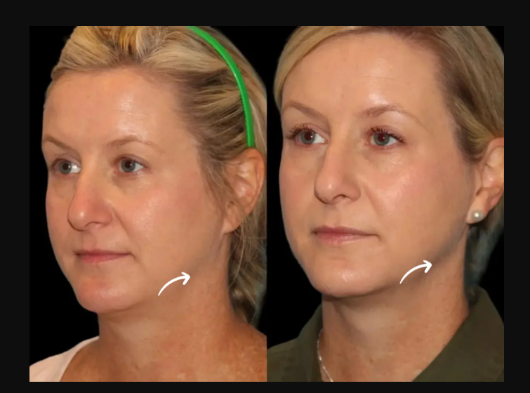 How to Book a Consultation with the Best Plastic Surgeon in Dubai for Sculptra Fillers