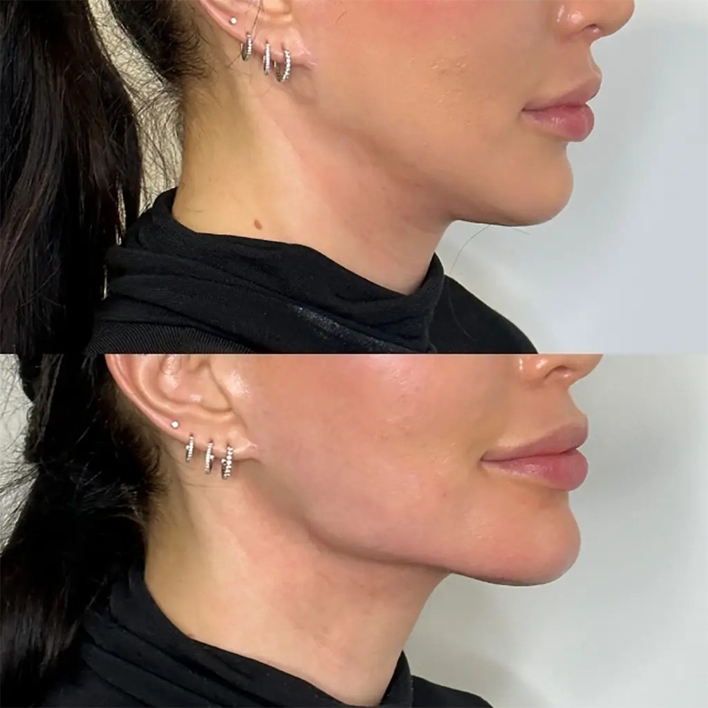 jawline fillers in dubai