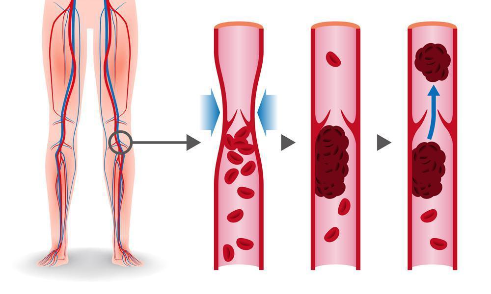 Recognizing DVT Symptoms: When to See a Doctor