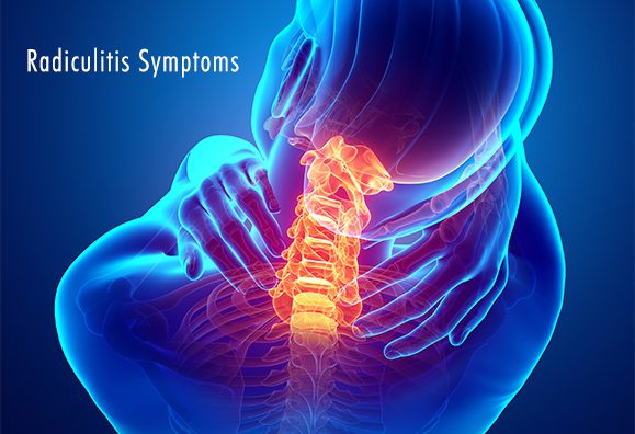 manage radicular pain