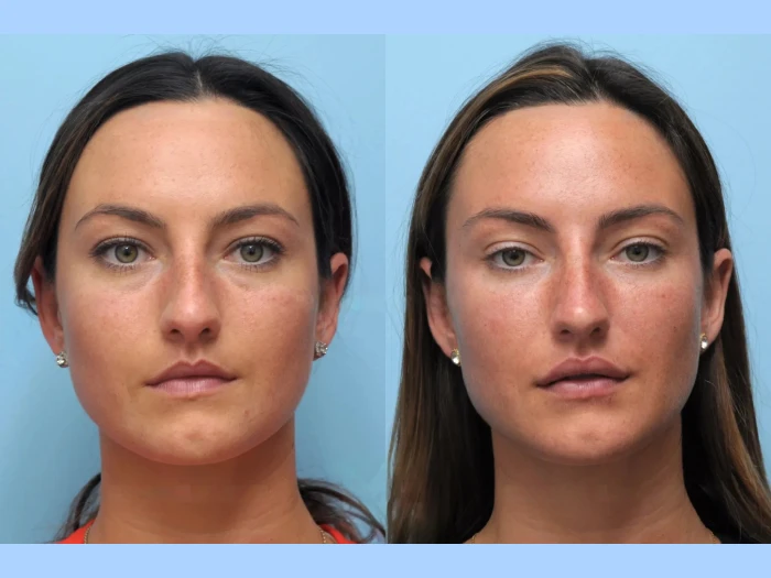 Why These Are the Best Aesthetic Clinics in Dubai for Thread Lift