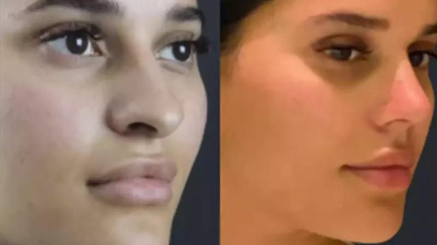 Minimally Invasive Septoplasty in Dubai: The Latest Techniques
