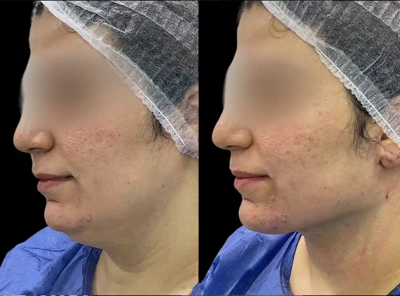 Chin Fillers Clinics in dubai
