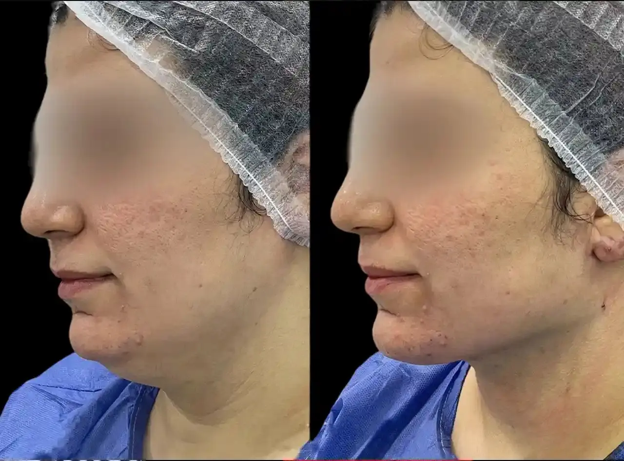 Chin Fillers Clinics in dubai
