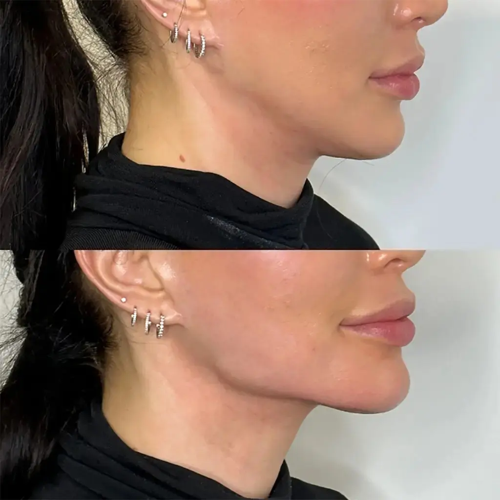 Jawline Fillers Clinics in dubai