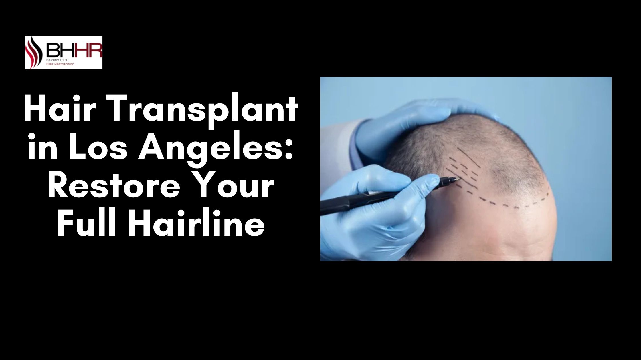 Hair Transplant in Los Angeles: Restore Your Full Hairline