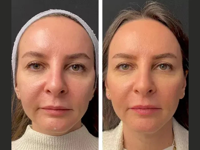 Comparing Mesotherapy Services at the Best Aesthetic Clinics in Dubai: A 2025 Guide