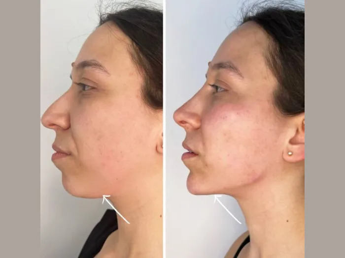 Experience Skin Tightening with Endolift at the Best Aesthetic Clinic in Dubai