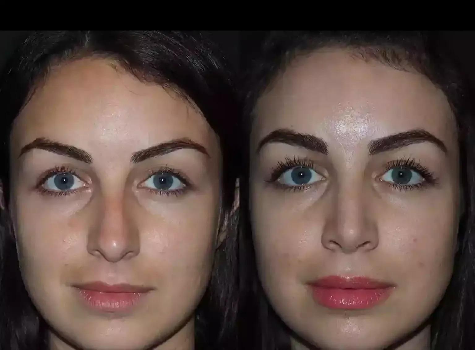 Breathing Reimagined: The Rise of Septoplasty in Dubai