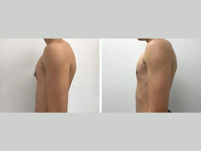 gynecomastia surgery in dubai