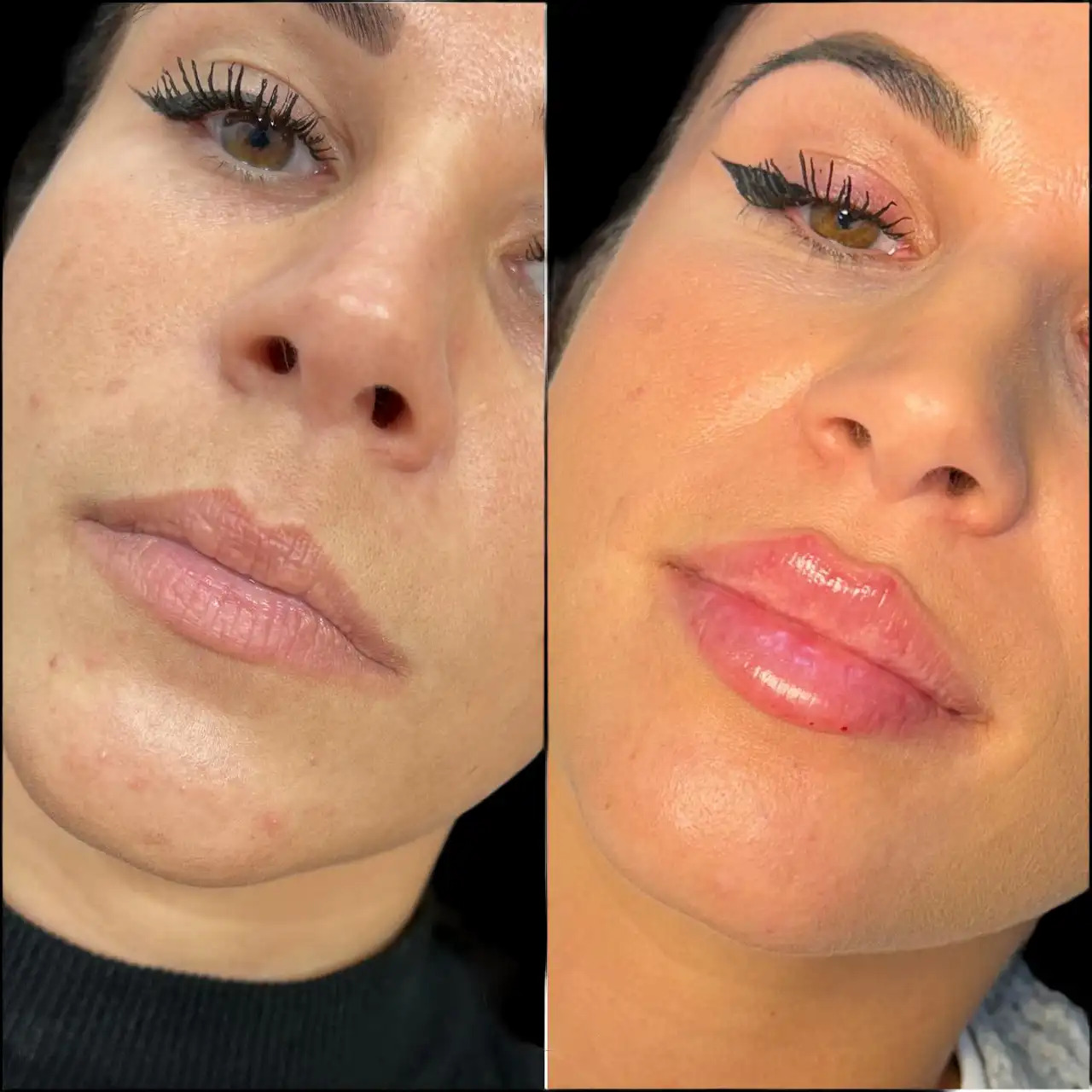 Achieve a Defined Chin with Dermal Fillers at the Best Aesthetic Clinics in Dubai