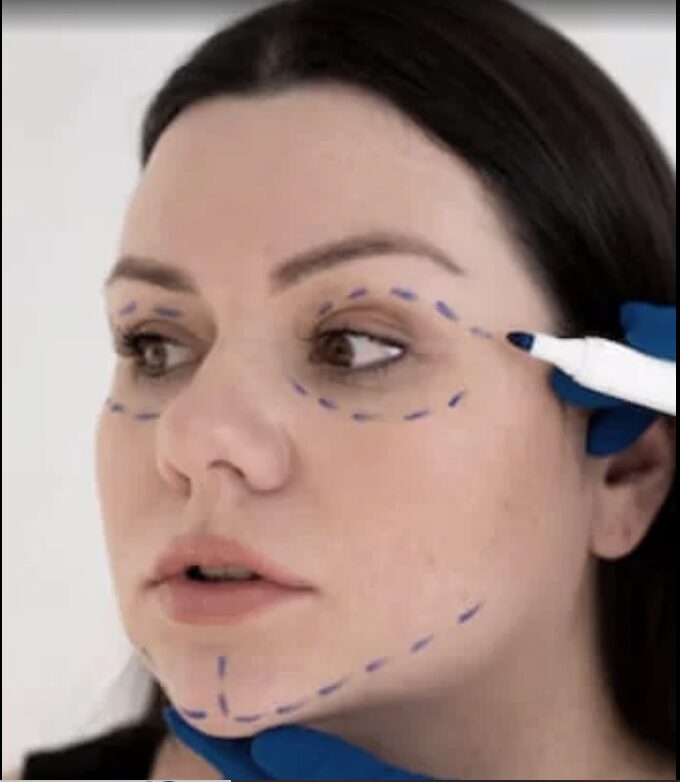 face-lipo