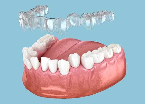What to Eat During Invisalign Treatment in Salford