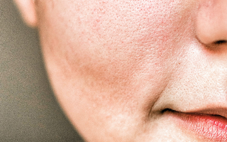 large-pores-treatment-in-Islamabad-2