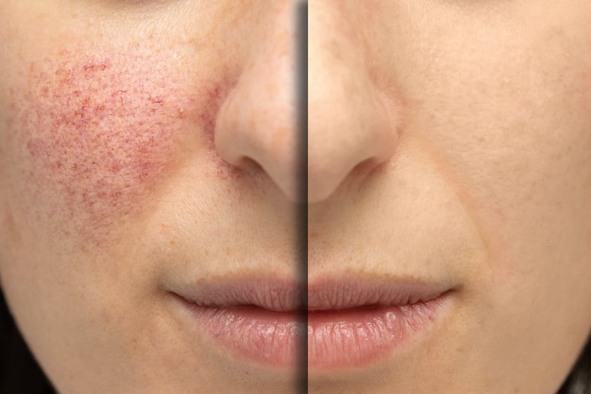 rosacea-treatment-in-Dubai