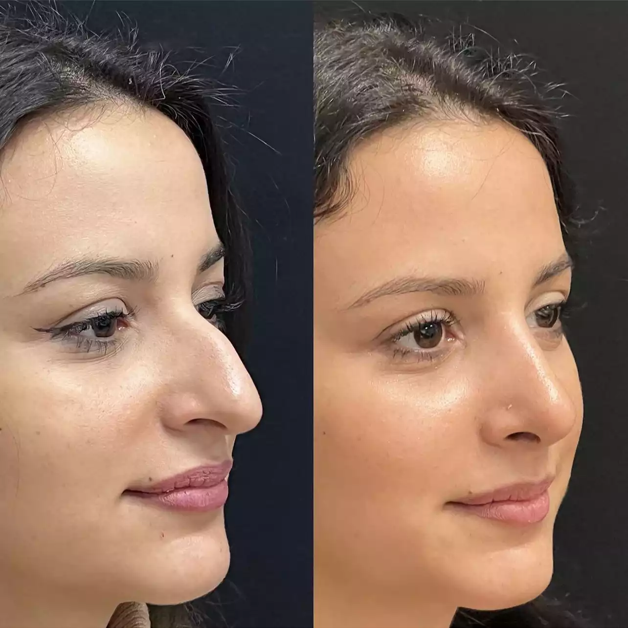 Rhinoplasty in Dubai: The Ultimate Guide for Overseas Patients