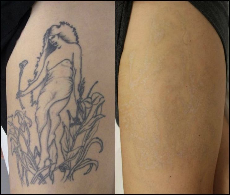 Tattoo Removal for Men and Women in Islamabad