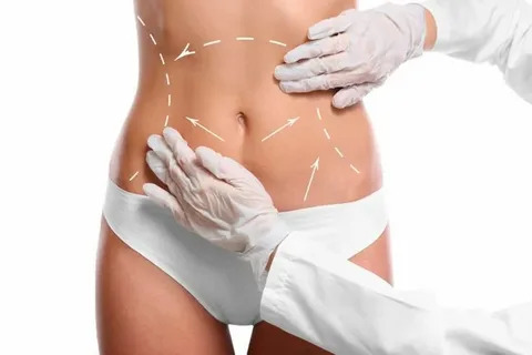 Liposuction in Islamabad: Benefits Beyond Weight Loss