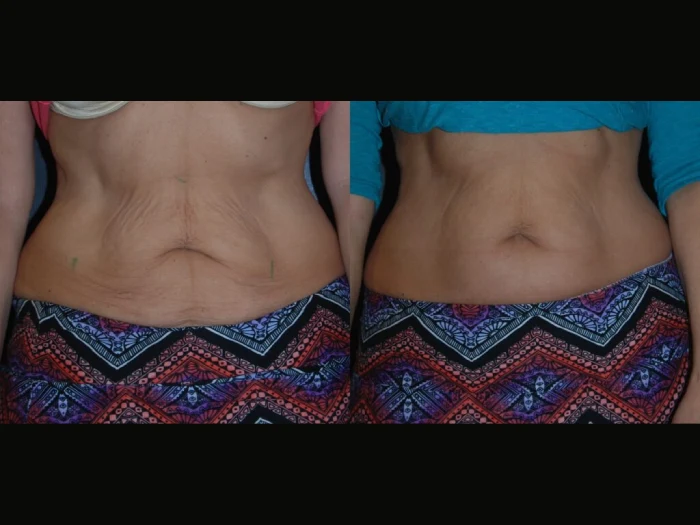 Expert Skin Tightening Treatment Care from the Best Doctors in Dubai