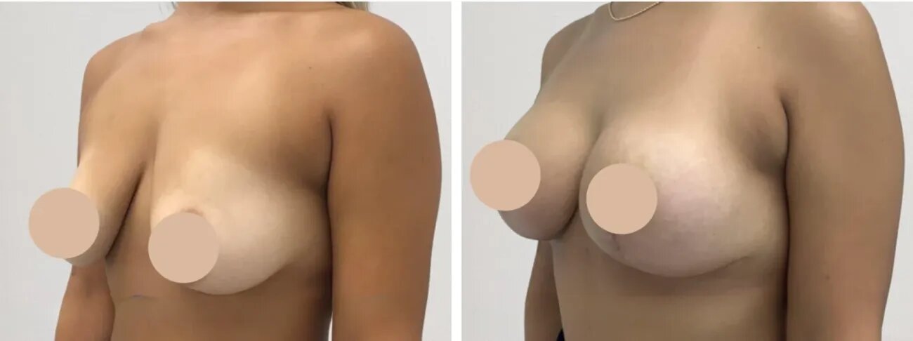 The Art of Beauty Redefined: Breast Lift in Dubai