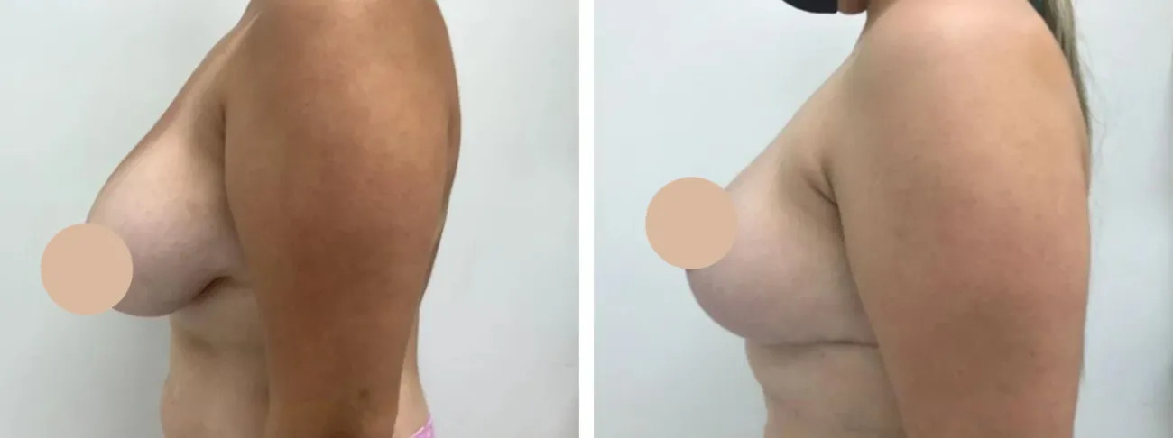 Stunning Results with the Best Breast Reduction Surgeons in dubai