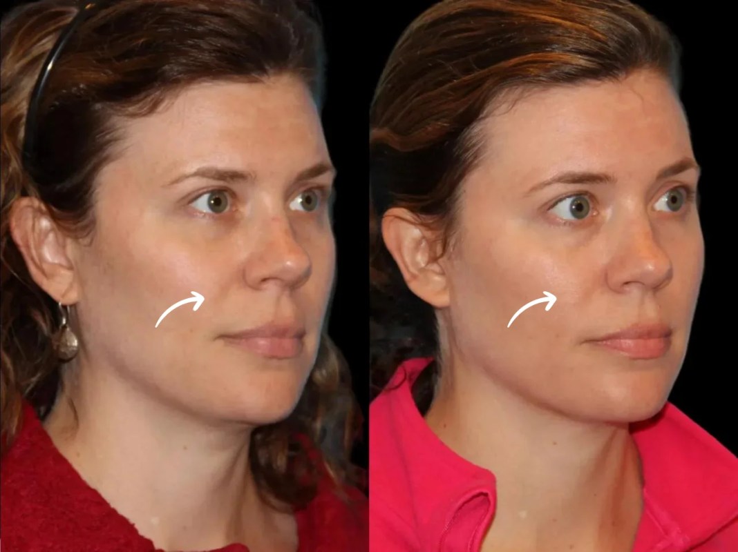 Best Plastic Surgeons in Dubai on Sculptra Fillers for Feminine Contours
