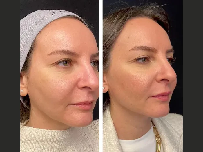 Best Plastic Surgeons in Dubai for Mesotherapy Anti-Wrinkle Solutions