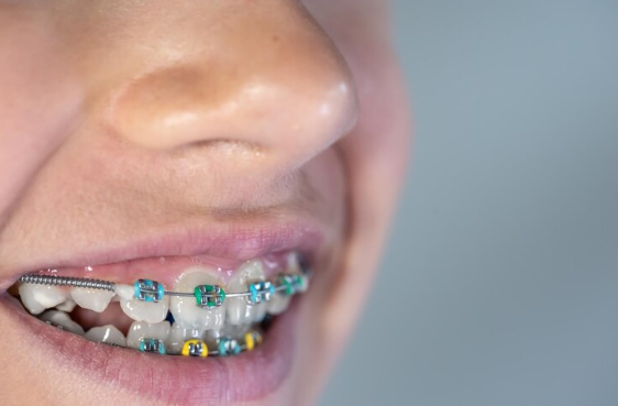 How Modern Orthodontics Is Reshaping Everyday Smile Confidence