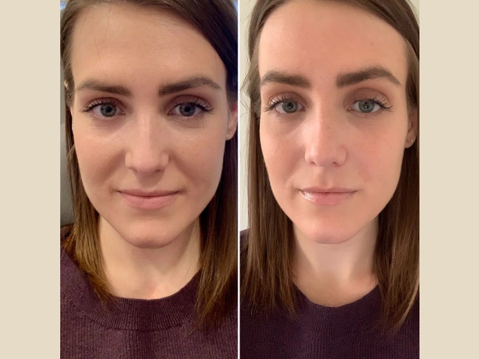 PRP Treatment in Dubai