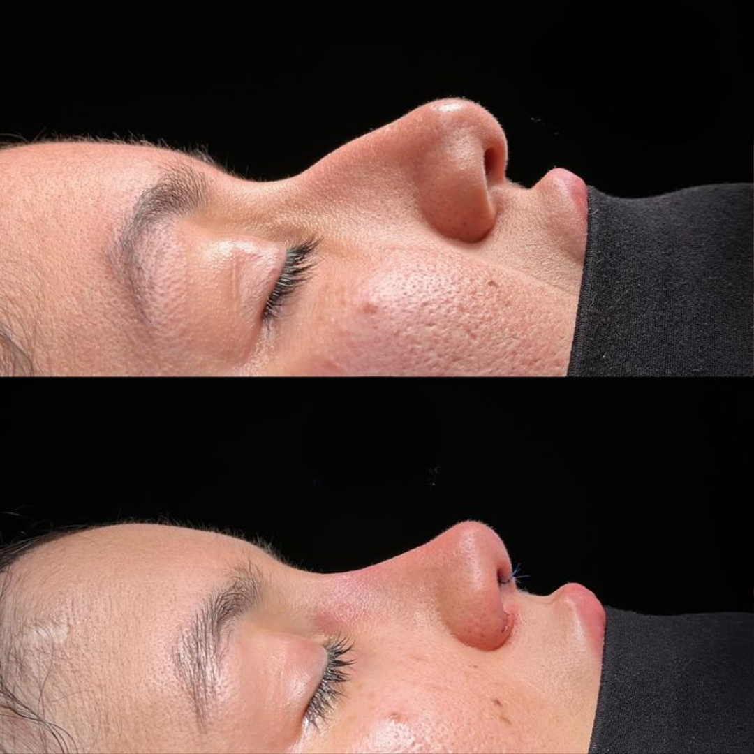 Achieve a Beautiful Nose with Rhinoplasty in Islamabad