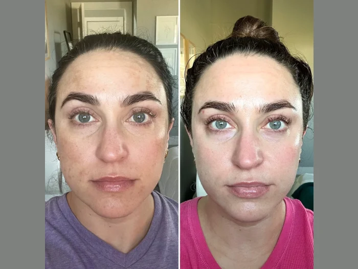 Transform Your Look with Skin Tightening by the Best Plastic Surgeon in Dubai