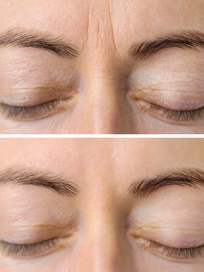 Why Forehead Wrinkle Treatments Are Popular in Mississauga