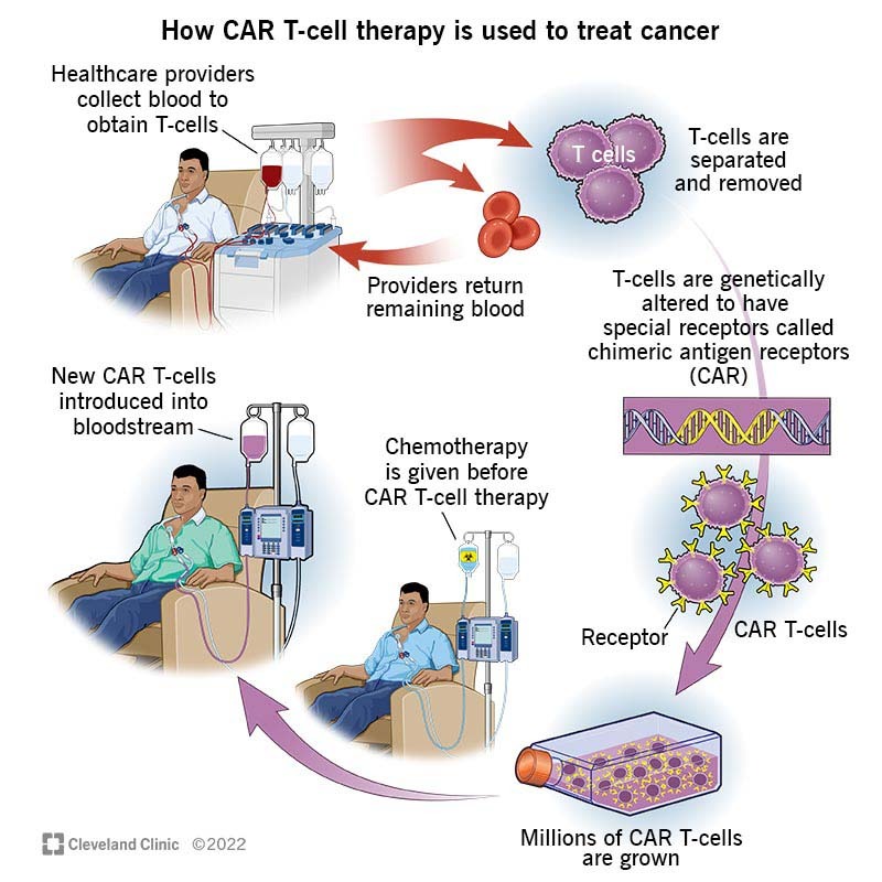 CAR-T-cell-treatment-for-lymphoma-India