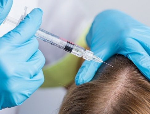 Can-PRP-Hair-Treatment-Be-Used-on-a-Receding-Hairline-1