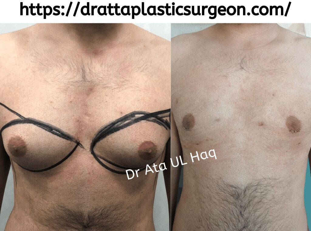 Gynecomastia-surgeon-in-Lahore