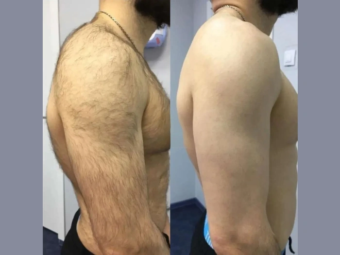 Electrolysis Laser hair removal in dubai