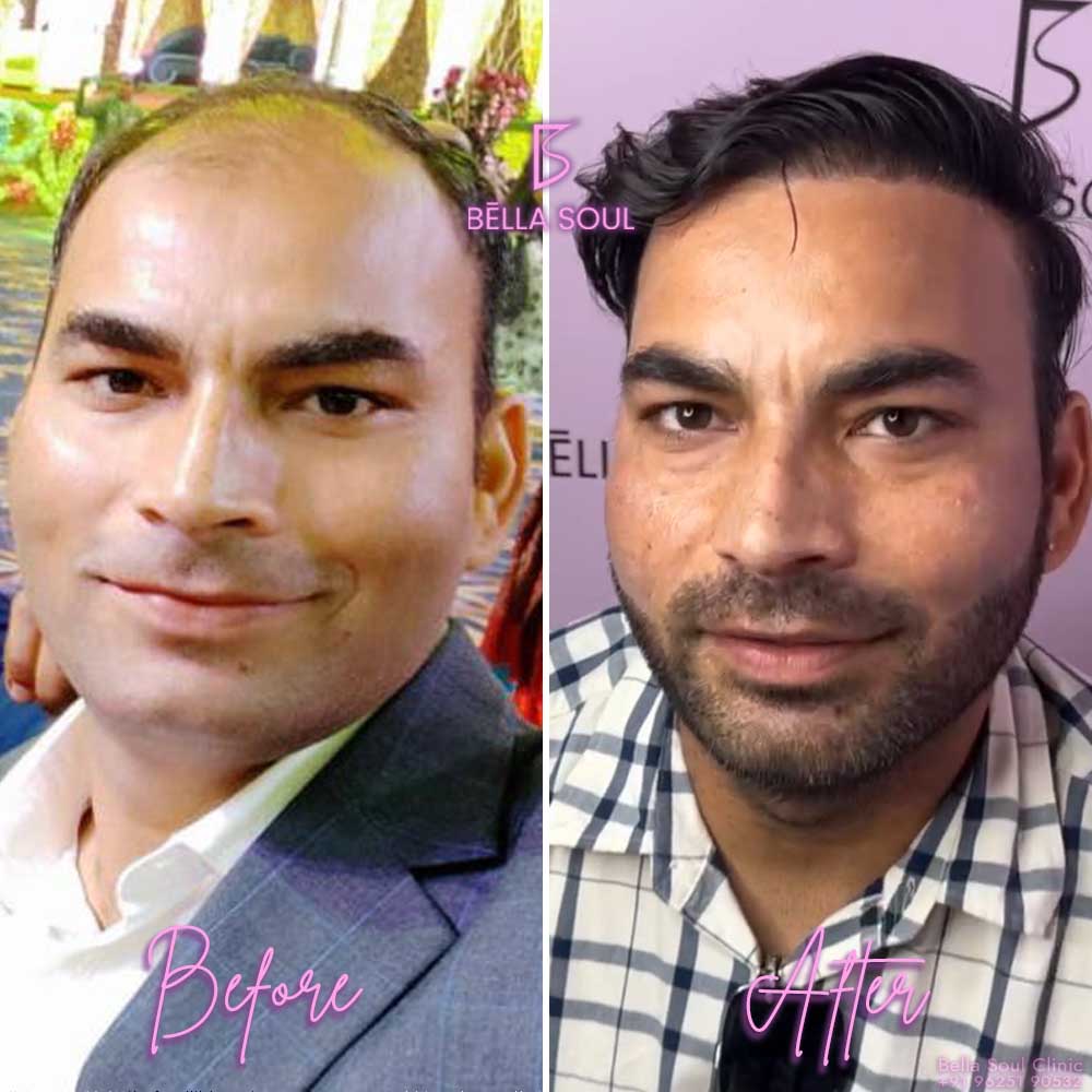 Hair Transplant in Delhi, Best Hair Transplant Clinic in Delhi